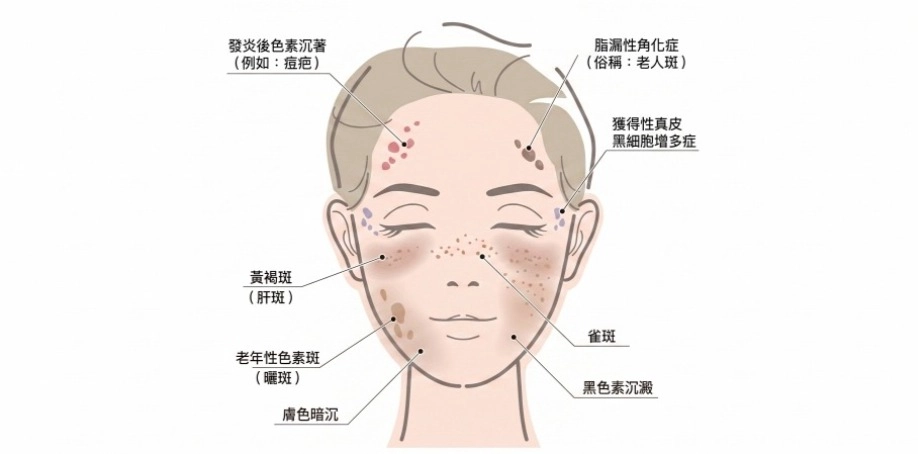 筋膜提升